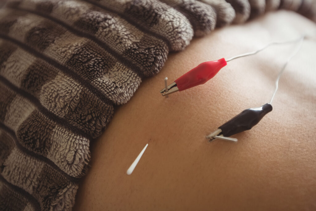 The Benefits of Acupuncture
