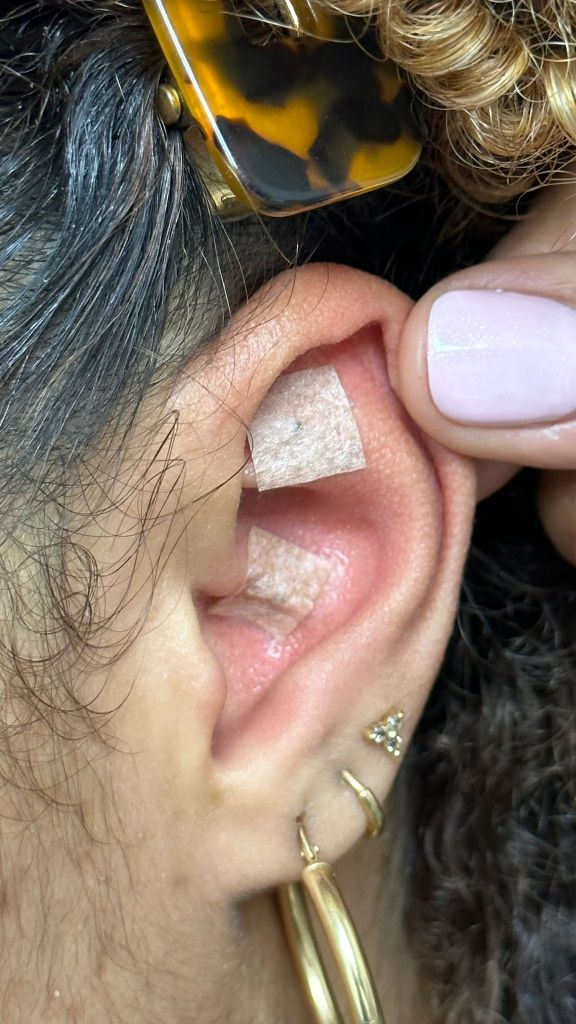 Patient getting ear seeds at Roots of Health
